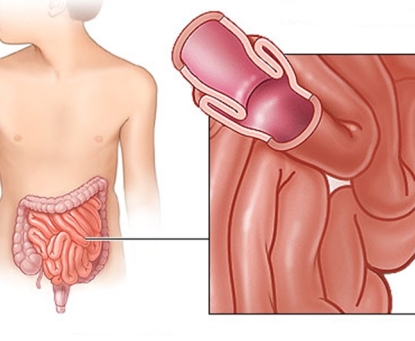Tổng quan bệnh lồng ruột 